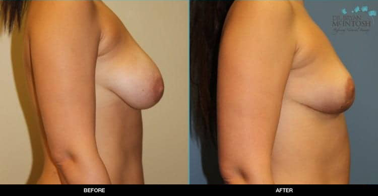 breast-reduction-1b