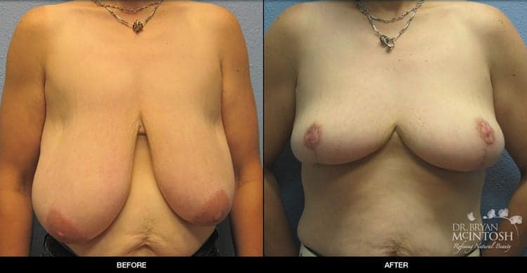 breast-reduction-2-1