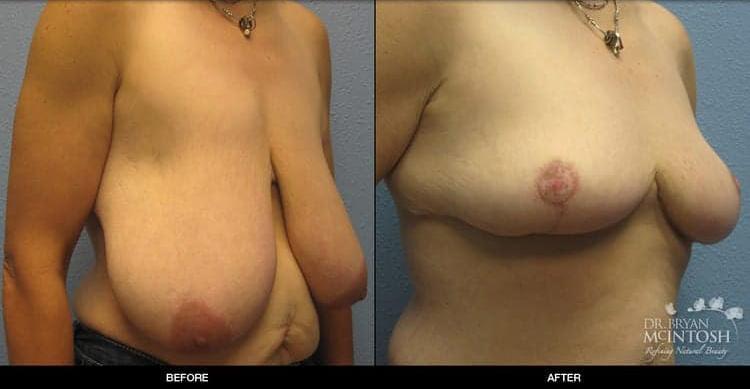 breast-reduction-2-2