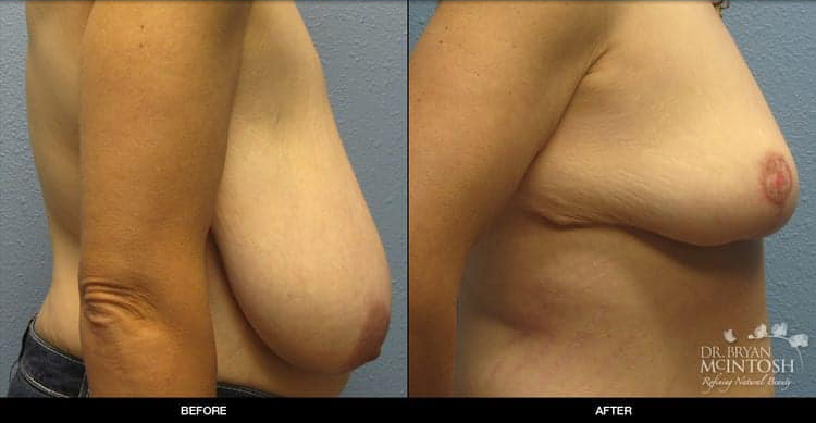 breast-reduction-2-3