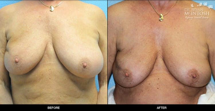 breast-reduction-3-1