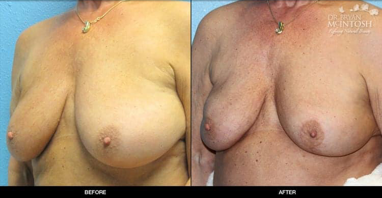 breast-reduction-3-2