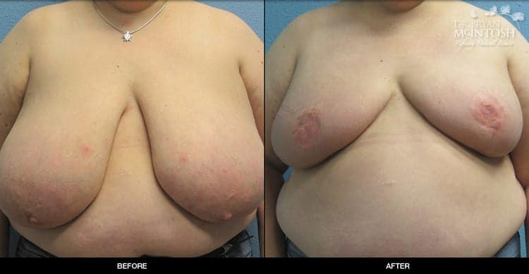 breast-reduction-4-1