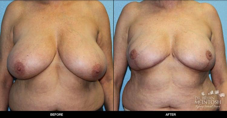 breast-reduction-5-1