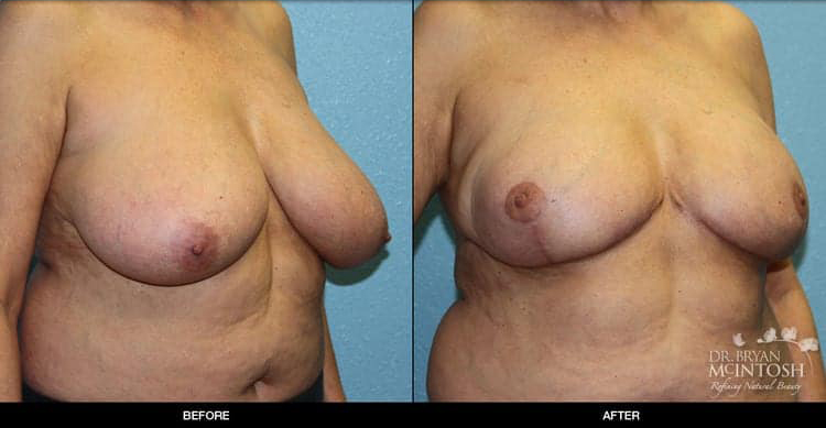 breast-reduction-5-2