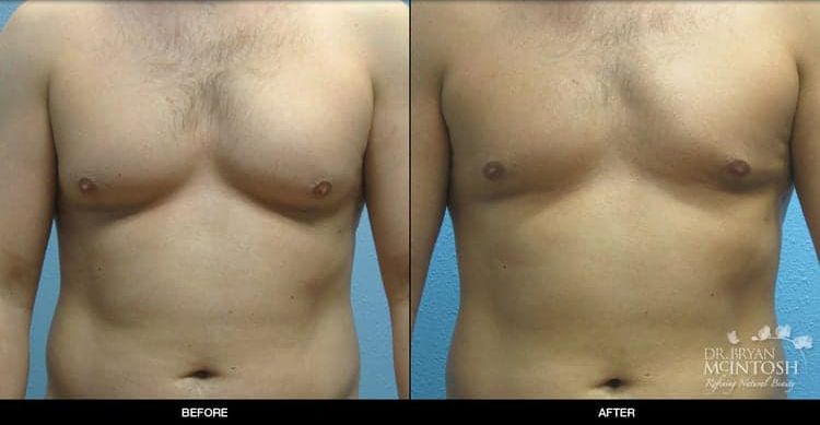breast-reduction-male-1-1