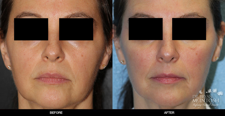 cheek-filler-1-1