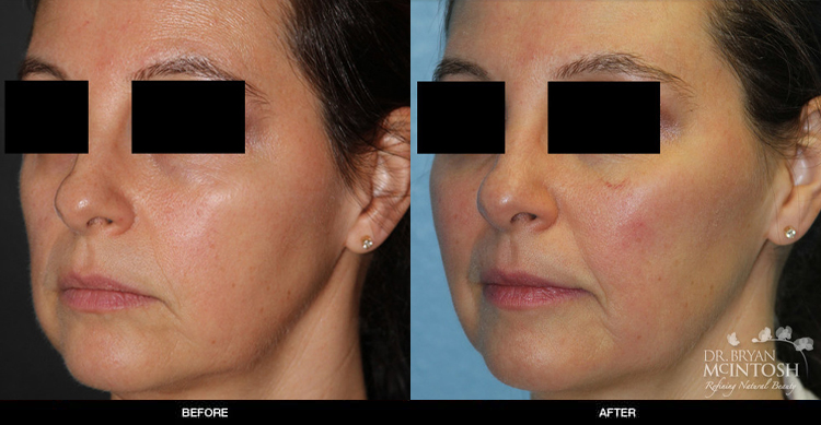 cheek-filler-1-2