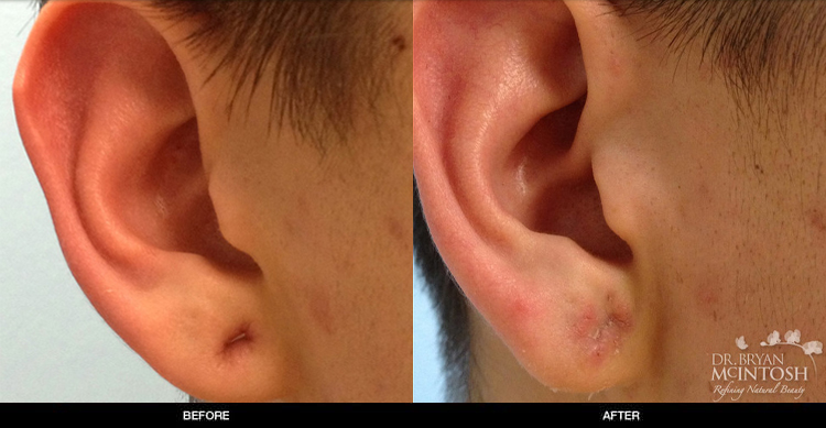 ear-lobe-repair-1-1