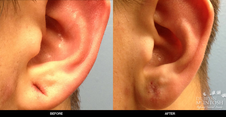 ear-lobe-repair-2-1
