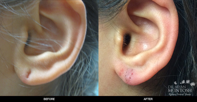 ear-lobe-repair-3-1