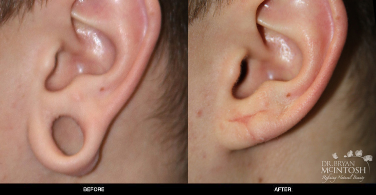ear-lobe-repair-4-1