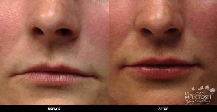 lip-augmentation-1-1