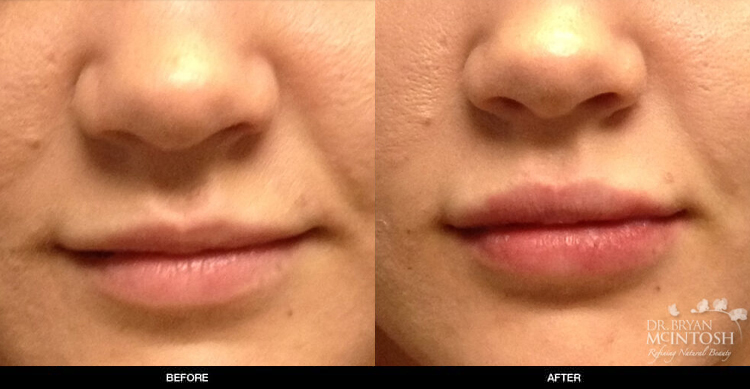 lip-augmentation-2-1