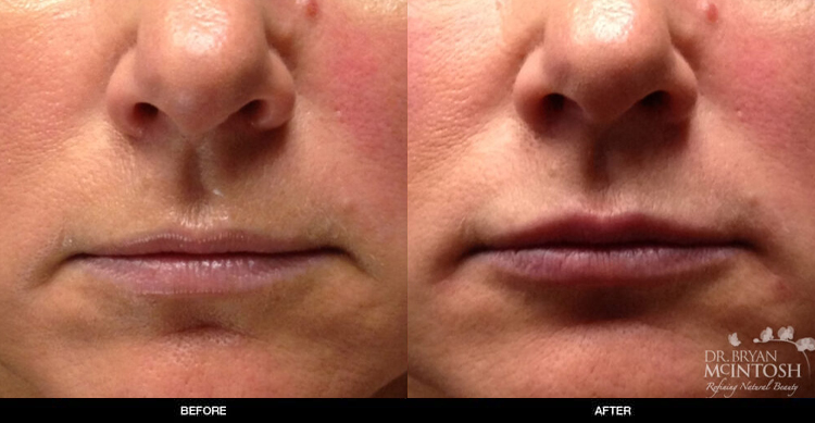lip-augmentation-3-1