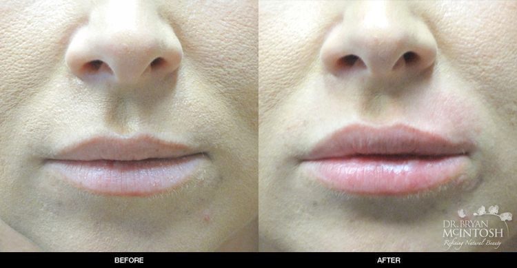 lip-augmentation-4-1