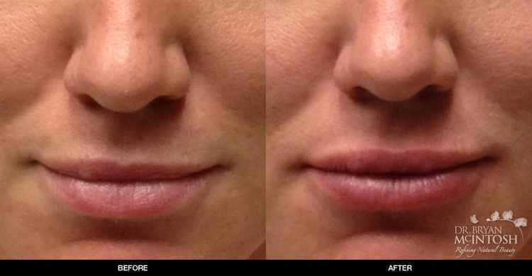 lip-augmentation-5-1