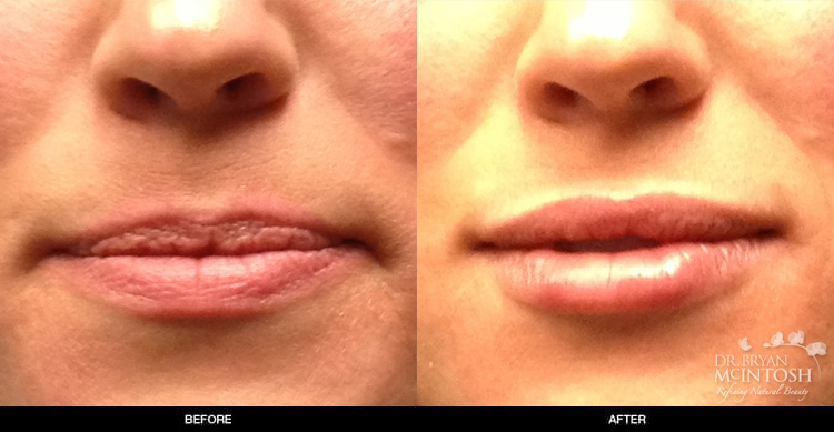 lip-augmentation-6-1