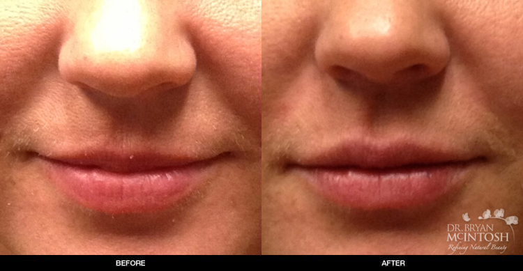 lip-augmentation-7-1
