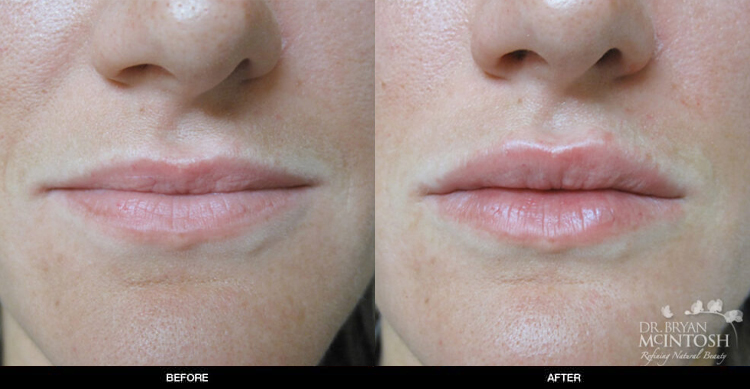 lip-augmentation-8-1