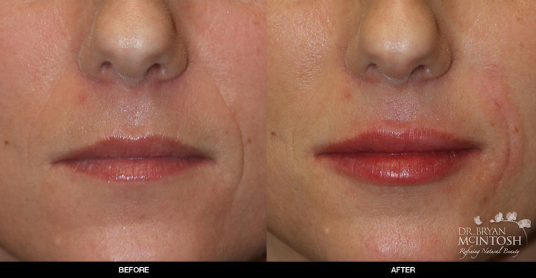 lip-augmentation-9-1
