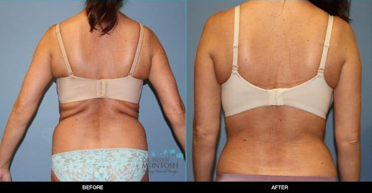 liposuction-to-the-abdomen-and-waist-and-a-back-lift2