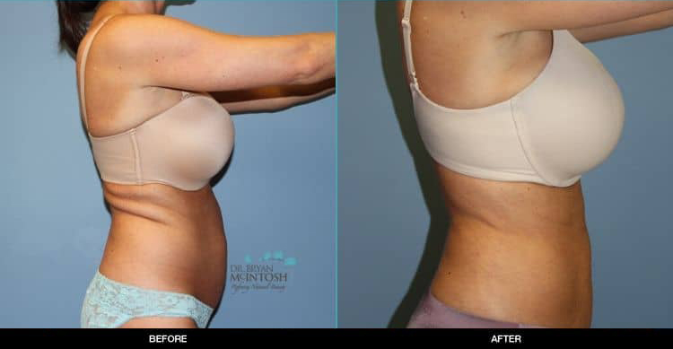 liposuction-to-the-abdomen-and-waist-and-a-back-lift3