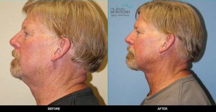 neck-lift-1b