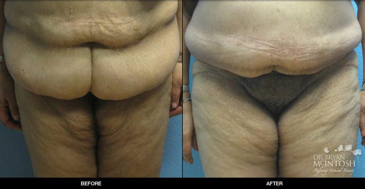 panniculectomy-1-1