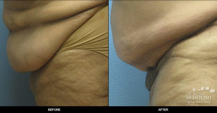 panniculectomy-1-2