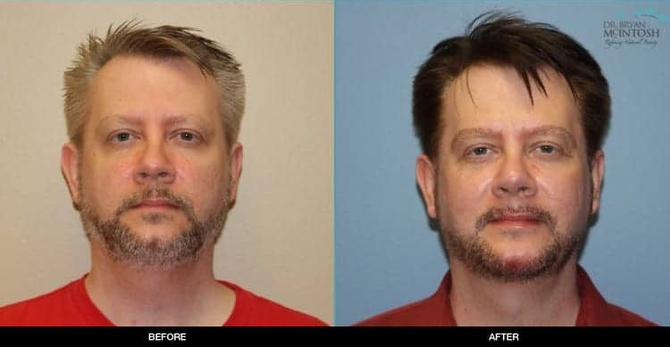 rhinoplasty-neck-lift-co2-laser-chin-augmentation-1a
