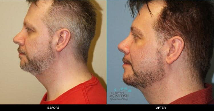 rhinoplasty-neck-lift-co2-laser-chin-augmentation-1b