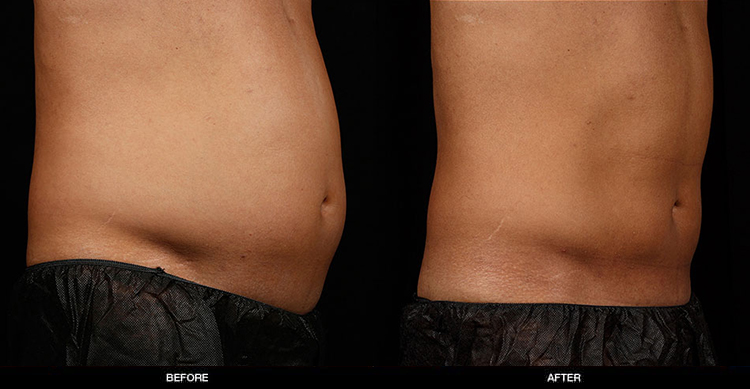 sculpsure-body-contouring-1