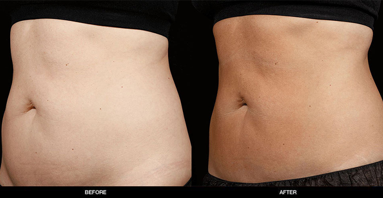 sculpsure-body-contouring-2