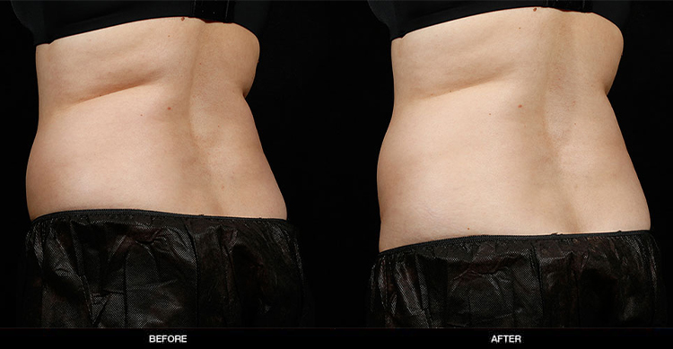 sculpsure-body-contouring-3
