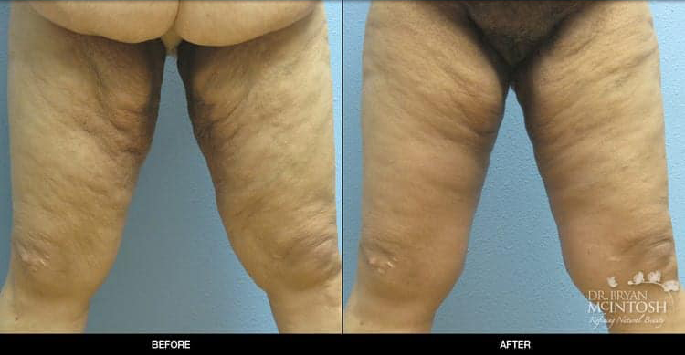thigh-lift-1-1