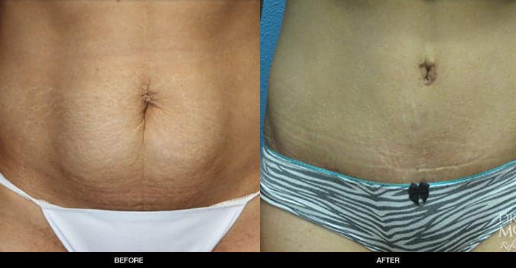 tummy-tuck-1-1b