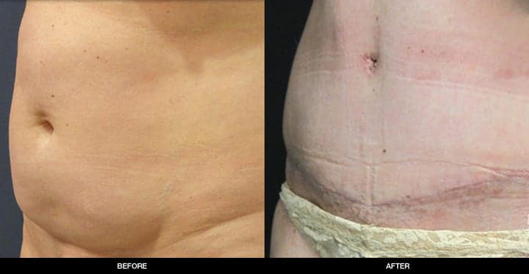 tummy-tuck-2-2b