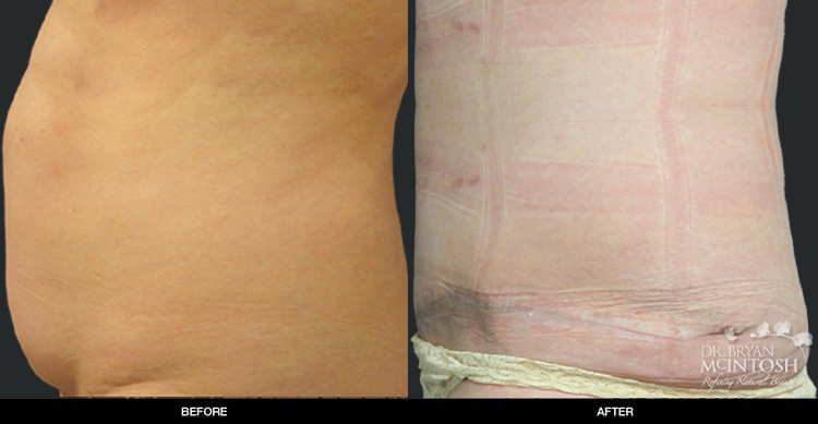 tummy-tuck-2-3b