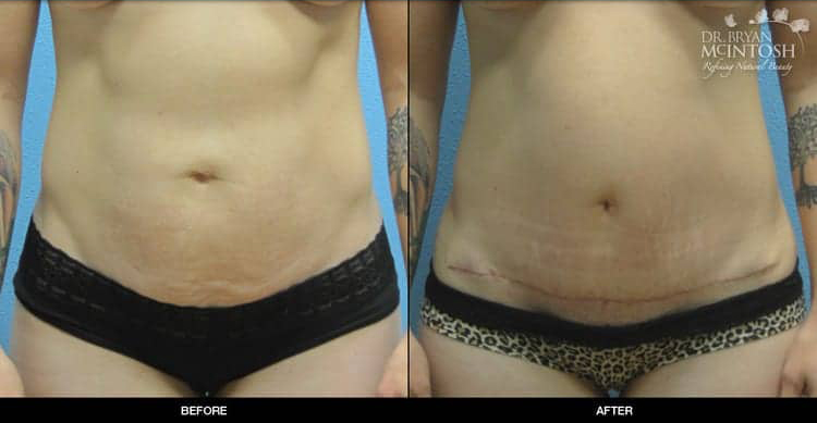 tummy-tuck-mini-1-1