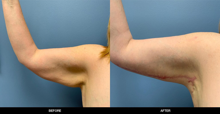 Arm Lift