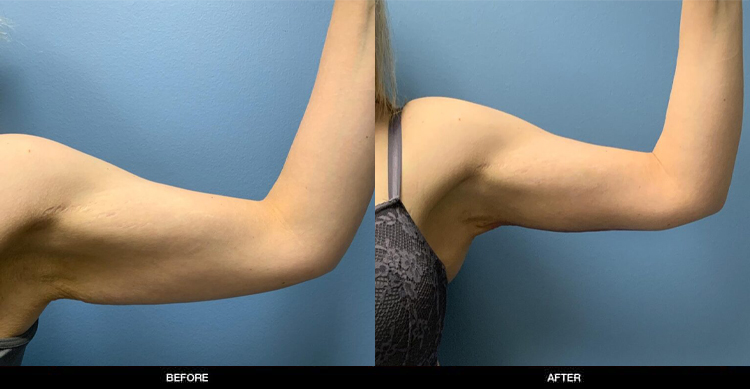 Arm Lift2