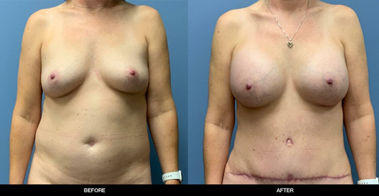 Breast-Augmentation-7-4