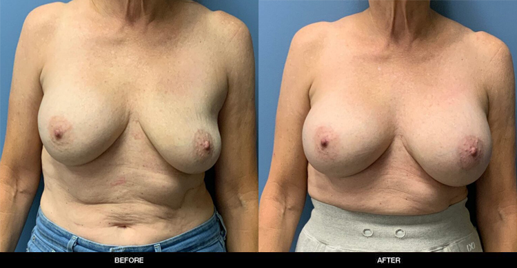 Breast-Augmentation-7-5
