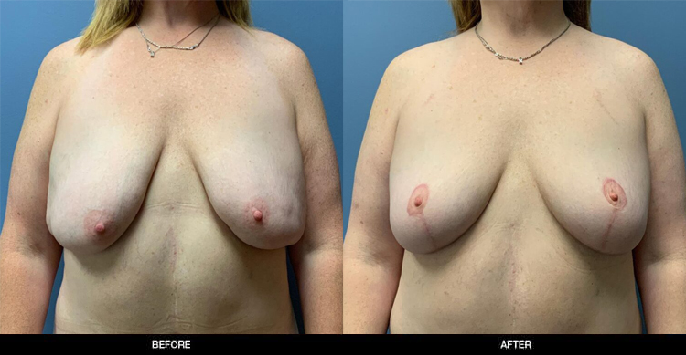 Breast-lift-2