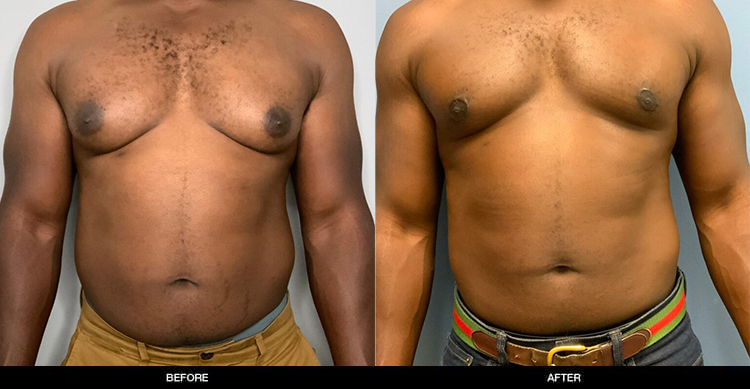 Gynecomastia