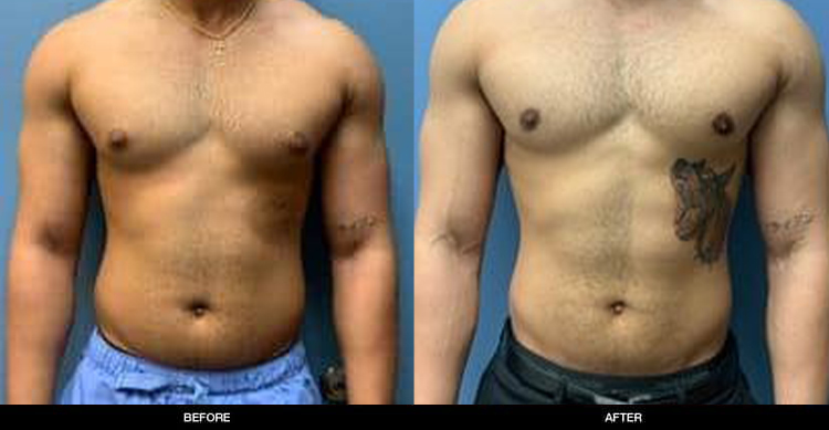 Gynecomastia2