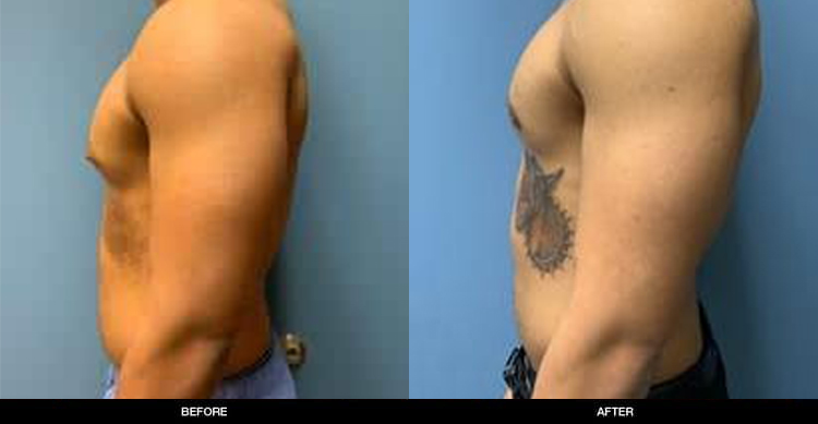 Gynecomastia3