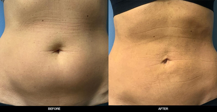 Liposuction