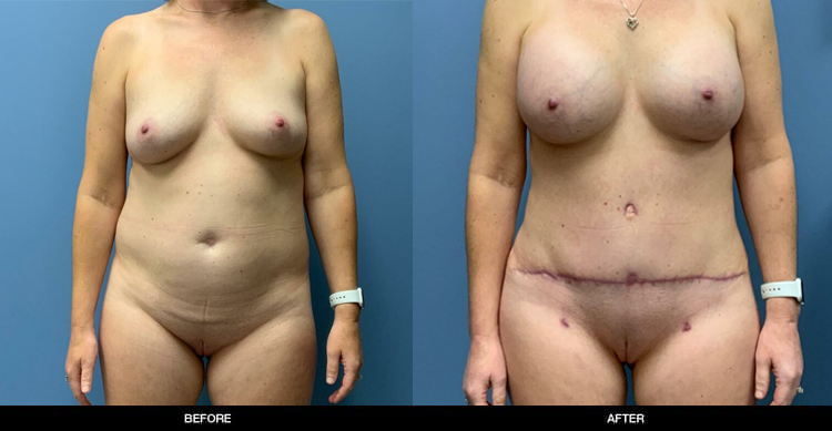 Liposuction2